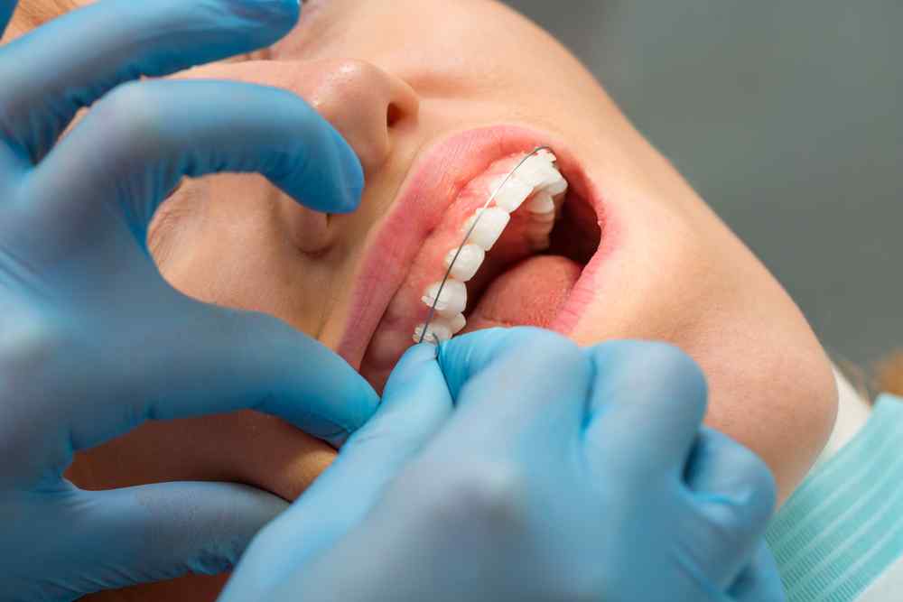 Habis Pasang Kawat Gigi? Jangan Lupa Lakukan 6 Perawatan Ini!